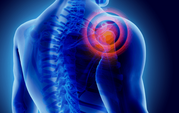 Frozen shoulder