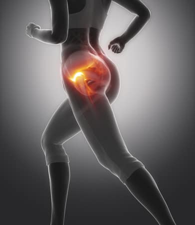 Gluteus tendinopathie