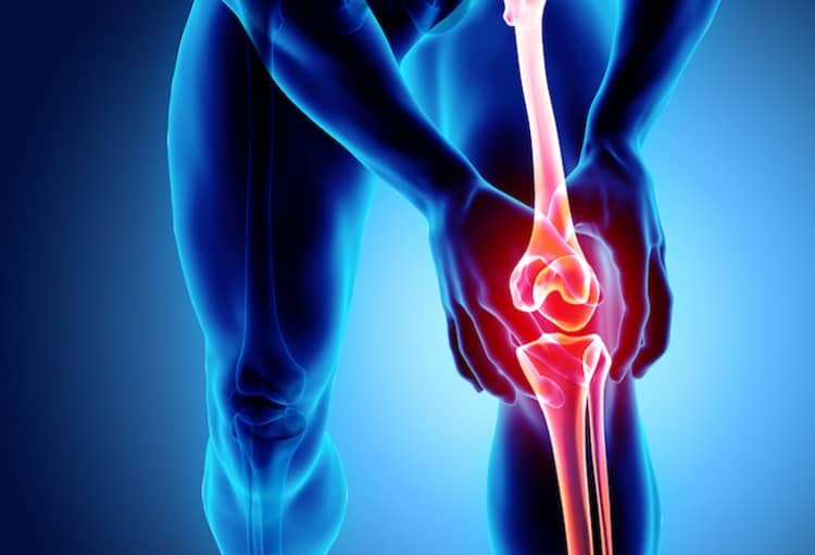 osteoarthritis knie